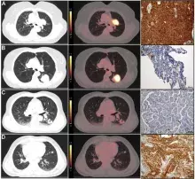 Zdjęcia pierwotnych nowotworów płuc wykazujących różny poziom aktywności metabolicznej